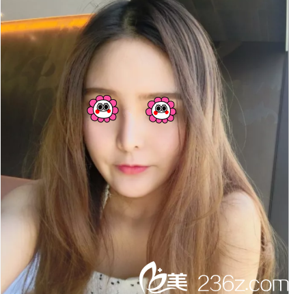 北京印正山<!--<i data=20240703-sp></i>-->给我做面部脂肪填充第13天效果 北京印正山<!--<i data=20240703-sp></i>-->给我做面部脂肪填充第13天效果