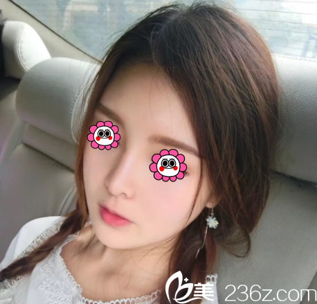 在北京印正山做面部脂肪填充三个月效果 在北京印正山做面部脂肪填充三个月效果