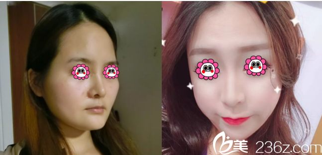 北京印正山面部脂肪填充前后对比效果 北京印正山面部脂肪填充前后对比效果