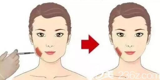 打瘦脸不良影响：不能频繁的打