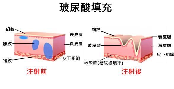 玻尿酸面部填充原理