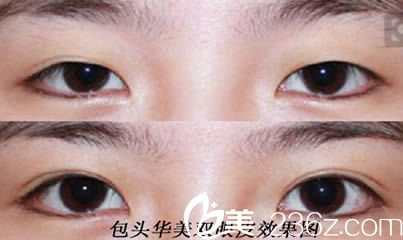 包头华美整形双眼皮案例效果对比图 包头华美整形双眼皮案例效果对比图