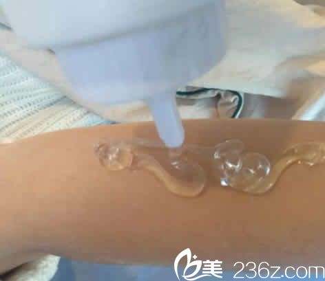 我在太原欧美莲整形做激光脱毛术中