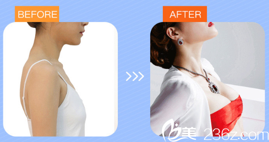 湛江澳泰整形医院张维华做的隆胸案例