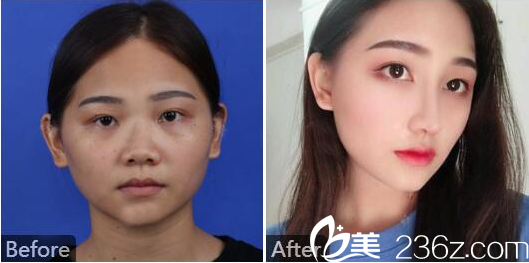 湛江澳泰整形医院张维华隆鼻案例图