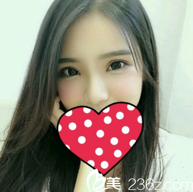 张维华做的双眼皮隆鼻术后7天 张维华做的双眼皮隆鼻术后7天