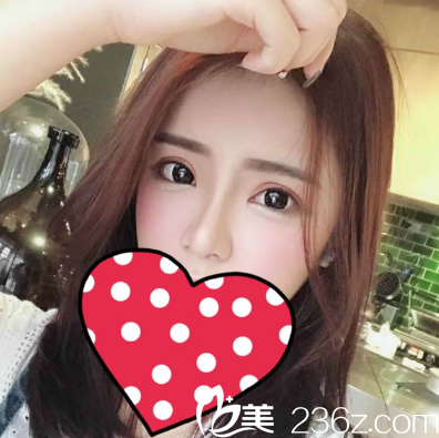 湛江澳泰整形医院双眼皮隆鼻脂肪填充案例图 湛江澳泰整形医院双眼皮隆鼻脂肪填充案例图