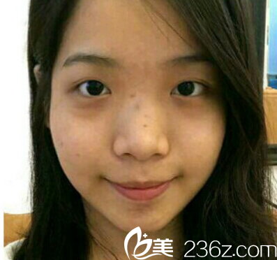 在湛江澳泰整形医院做双眼皮隆鼻手术前 在湛江澳泰整形医院做双眼皮隆鼻手术前