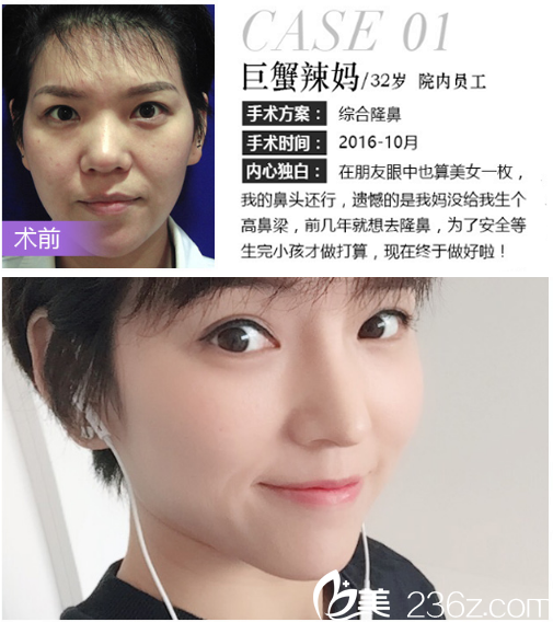 深圳米兰柏羽朱根武做的肋软骨隆鼻案例