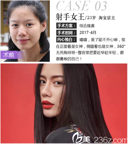 深圳米兰柏羽王志东做的隆鼻案例