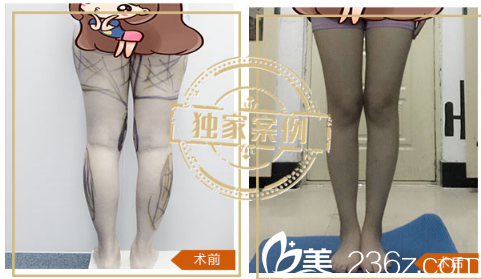 深圳米兰柏羽王志东大腿吸脂案例对比图