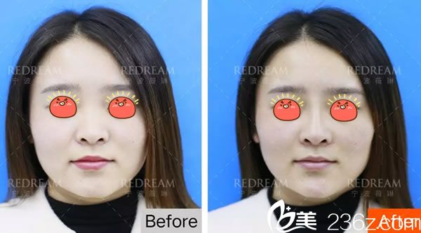 宁波薇琳曾举公主玻尿酸注射<span style= 宁波薇琳曾举公主玻尿酸注射<span style=