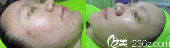周玲院长治疗祛痘效果对比案例