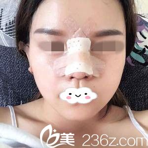 隆鼻术后第三天