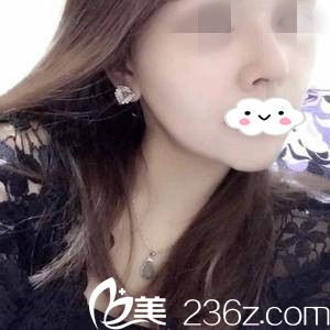 术后一周的效果