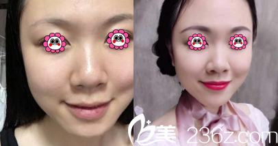 北京美易美时代医疗美容诊所李龙梅果酸换肤案例