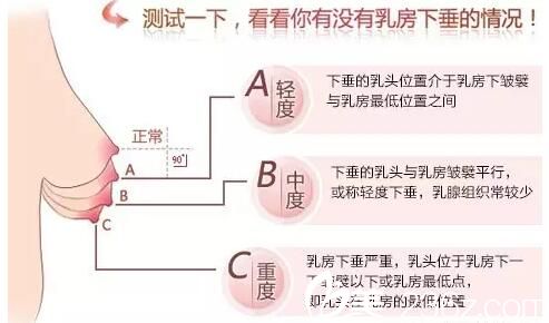 乳房下垂主要分为三种情况