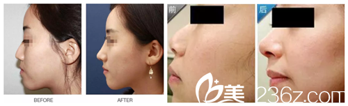 注射玻尿酸隆鼻案例 注射玻尿酸隆鼻案例