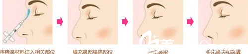 玻尿酸注射隆鼻流程 玻尿酸注射隆鼻流程