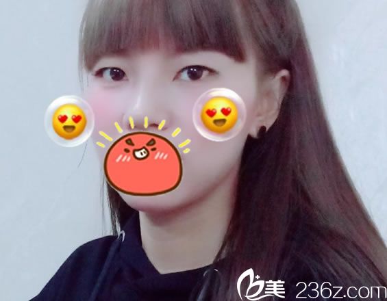 在台州博仕割双眼皮之前 在台州博仕割双眼皮之前