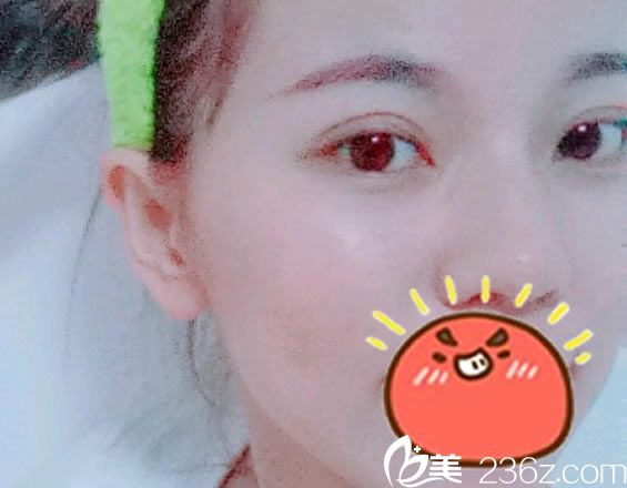 做完双眼皮开眼角综合手术15天效果 做完双眼皮开眼角综合手术15天效果