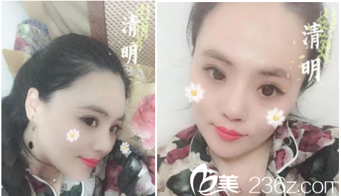 济南做鼻修复手术有名的医院是济南美莲，我在美莲做的鼻修复手术大家都说好看