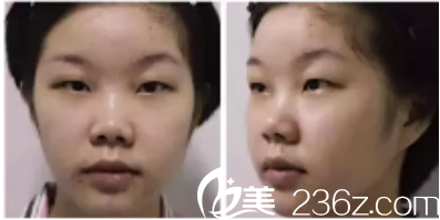 西安做埋线双眼皮+玻尿酸隆鼻差不多90天了 西安做埋线双眼皮+玻尿酸隆鼻差不多90天了