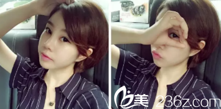 距离我在西安做埋线双眼皮+玻尿酸隆鼻差不多90天了，感觉不错