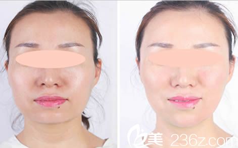 唐山苏亚美联臣面部轮廓效果对比图 唐山苏亚美联臣面部轮廓效果对比图