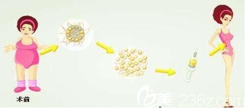 瘦子可以做自体脂肪隆胸吗?