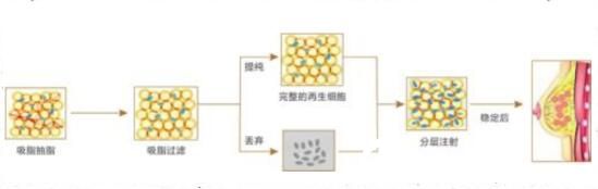 瘦人做自体脂肪隆胸会不会成活率低