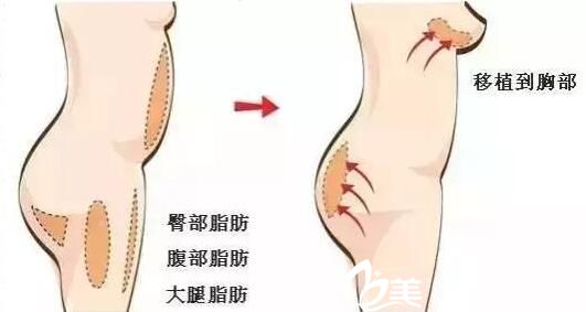  自体脂肪隆胸是怎么做的?