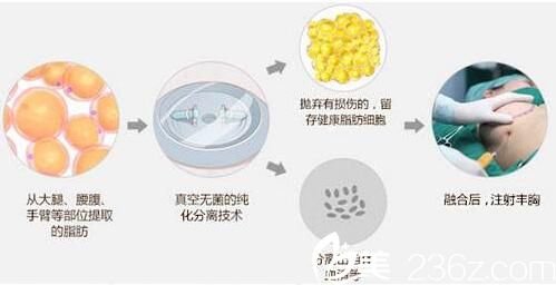自体脂肪移植隆胸手感好吗?