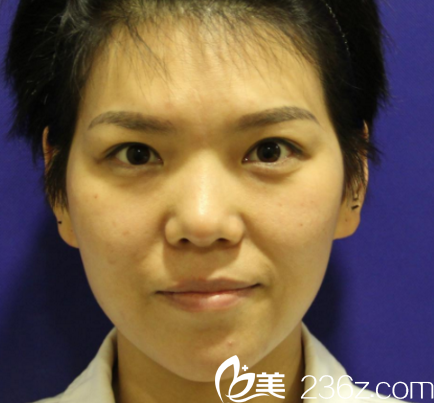 进来刚在西安做的鼻综合手术 进来刚在西安做的鼻综合手术