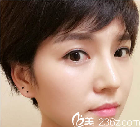 术后的样子 术后的样子