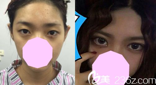 蚌埠国色整形医院好吗？程新德无痕双眼皮案例来验证