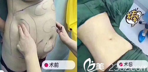 朱宝玉腰部环吸术后即刻对比图