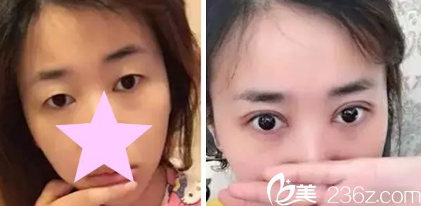 郑州芳艺整形美容医院全切双眼皮代表案例 郑州芳艺整形美容医院全切双眼皮代表案例