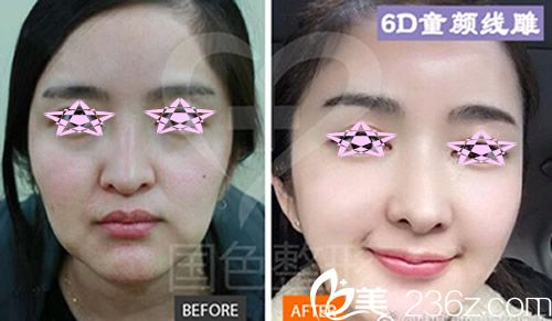 朱宝玉6D童颜线雕术前术后对比案例.jpg