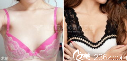 王明利自体脂肪丰胸案例 王明利自体脂肪丰胸案例