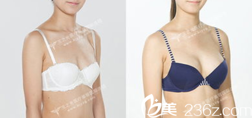 王明利假体隆胸案例 王明利假体隆胸案例