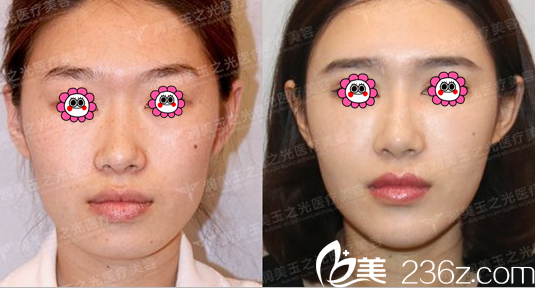 王明利面部脂肪填充案例 王明利面部脂肪填充案例