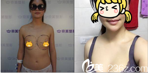 刘成胜自体脂肪隆胸案例