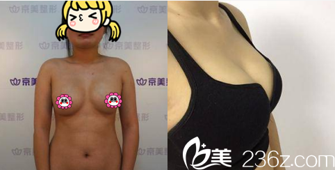 <!--<i data=20240703-sp></li>
<li><i data=20240703-sp></i>-->假体取出+脂肪丰胸案例