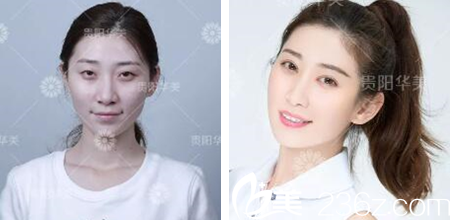 贵阳华美做双眼皮怎么样 贵阳华美做双眼皮怎么样