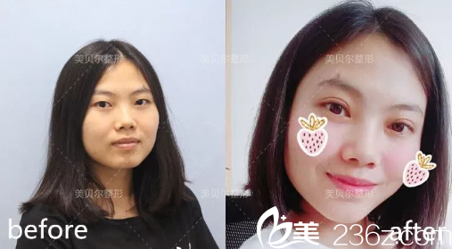 贵阳美贝尔整形双眼皮案例 贵阳美贝尔整形双眼皮案例