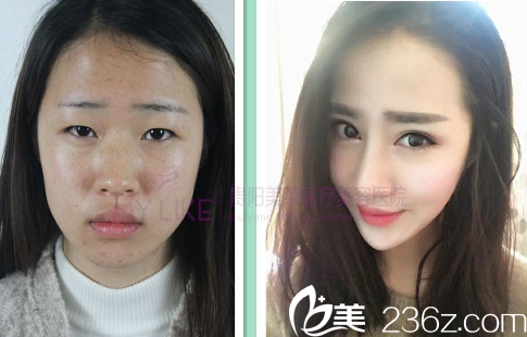 贵阳美莱割双眼皮效果好不好 贵阳美莱割双眼皮效果好不好