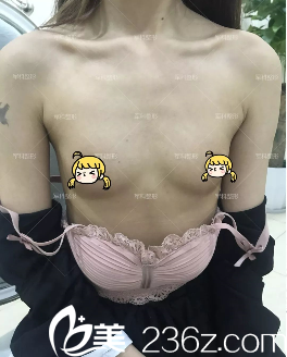 重庆军科整形JK内窥镜全感丰胸术 重庆军科整形JK内窥镜全感丰胸术