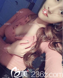 重庆军科赵亚均假体隆胸术后一个月 重庆军科赵亚均假体隆胸术后一个月