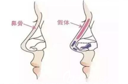 硅胶隆鼻副作用一:鼻形不美观 硅胶隆鼻副作用一:鼻形不美观